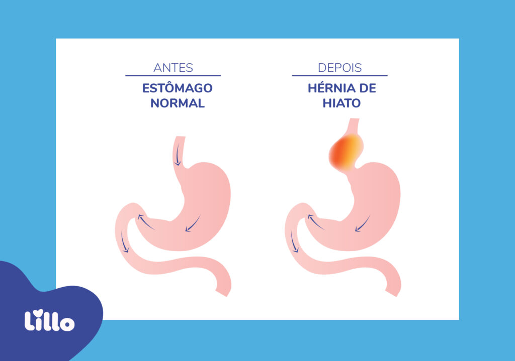 Estômago normal x estômago com hérnia de hiato