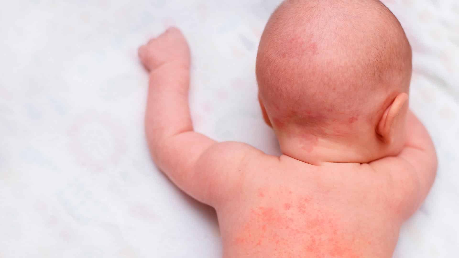 Bebê com alergia do calor