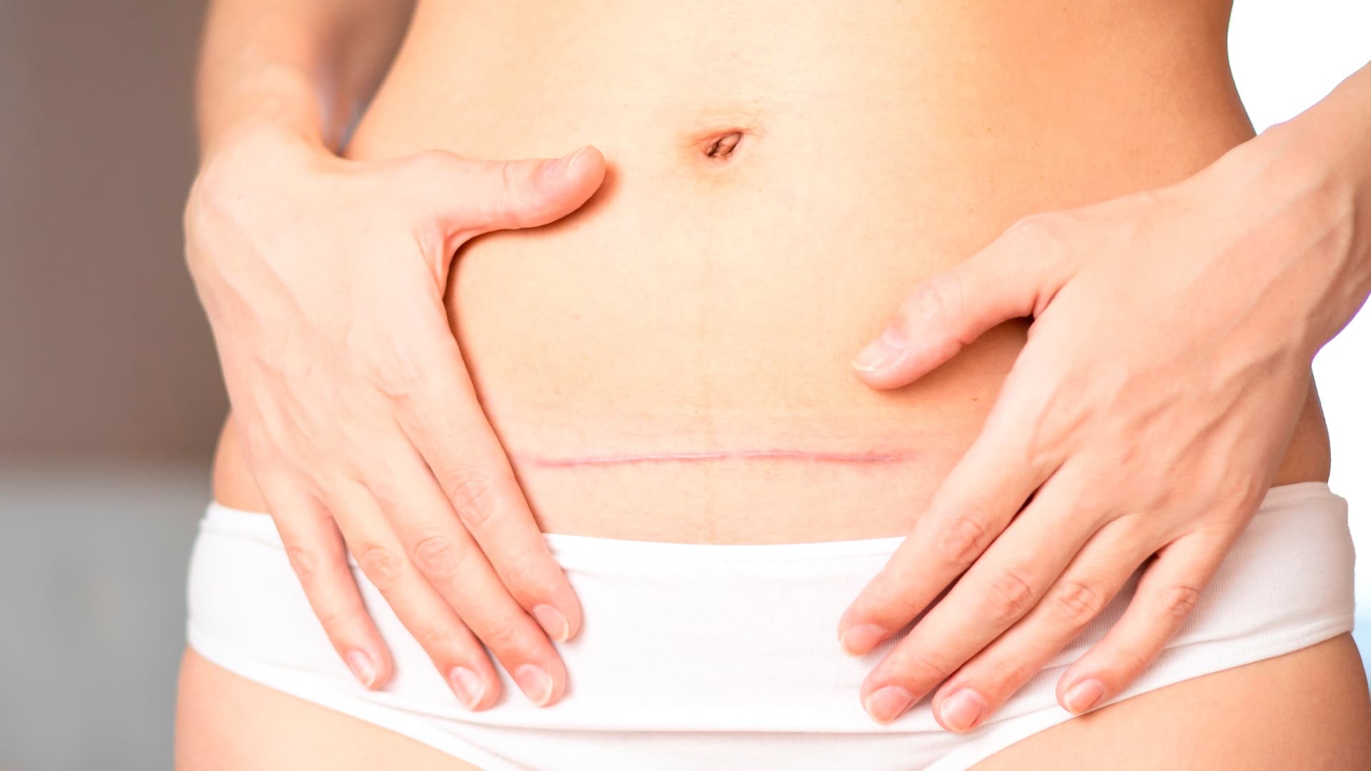 Cicatriz da cesárea: 3 problemas comuns e como resolver - Revista Crescer