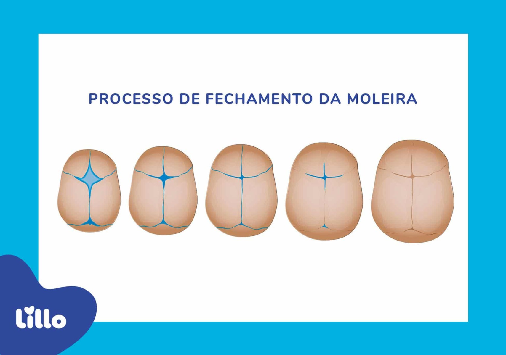 Ajudamos a entender o que é moleira ao compreender seu processo de fechamento