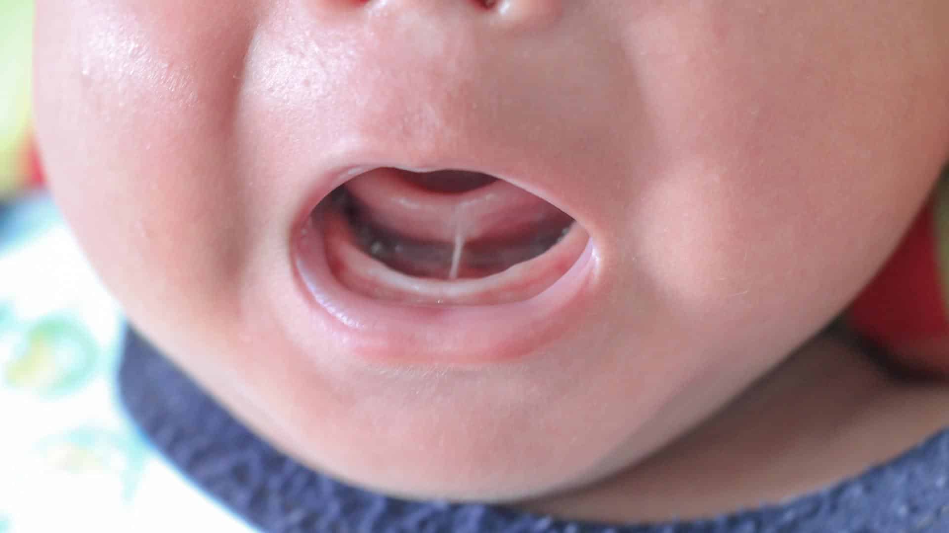 Língua presa no bebê