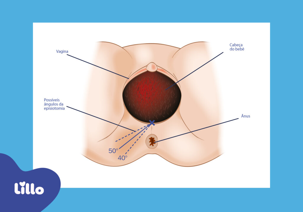 Ilustração de episiotomia