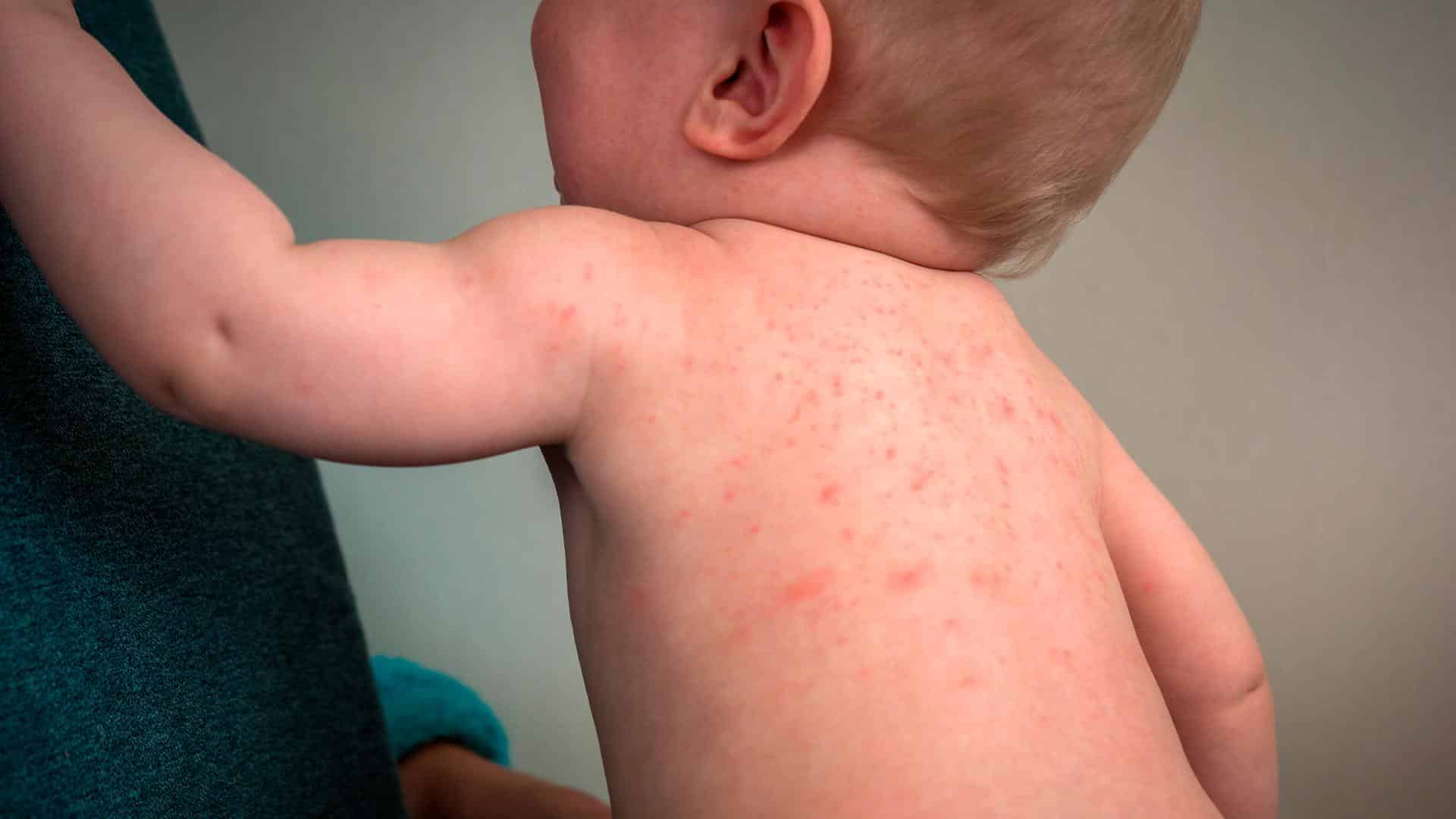 Bebê com alergia ao calor é algo até normal devido à sensibilidade da pele