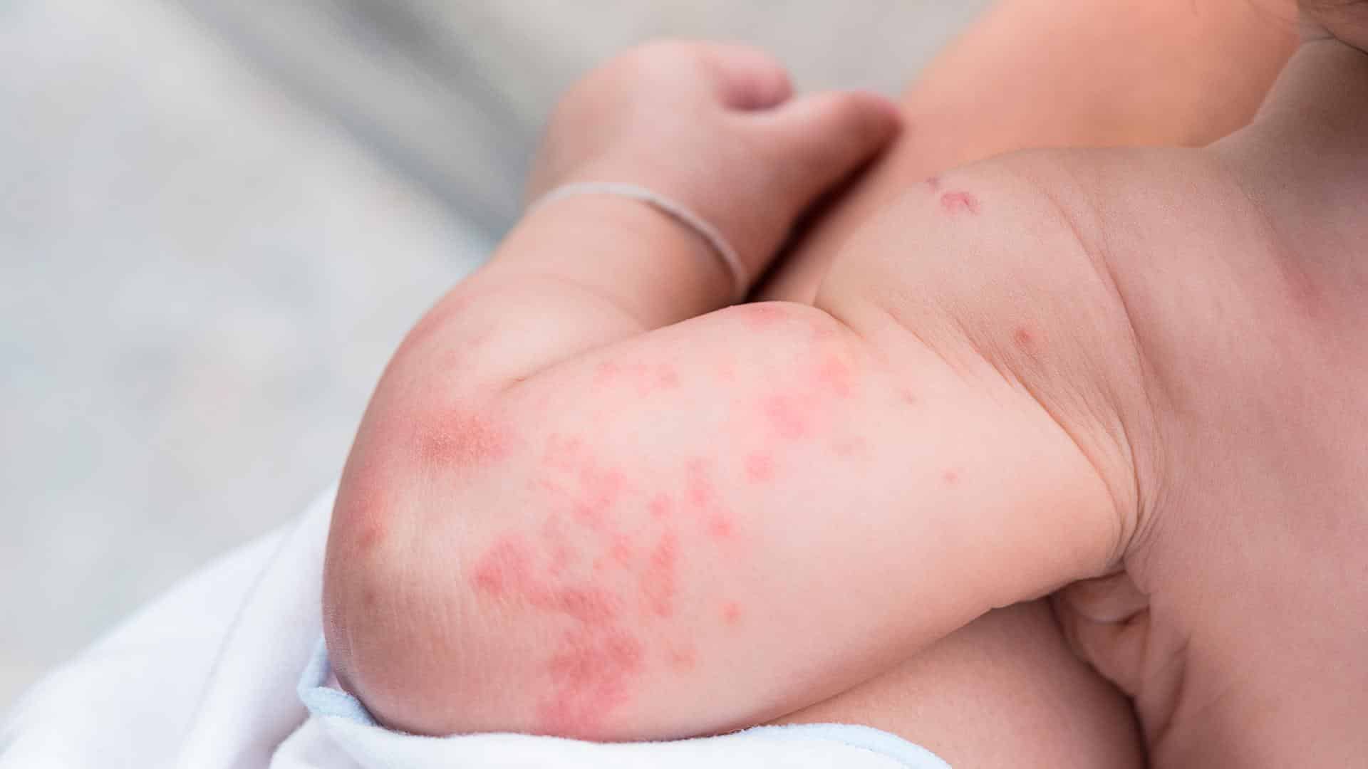 Braço de bebê com alergia ao calor