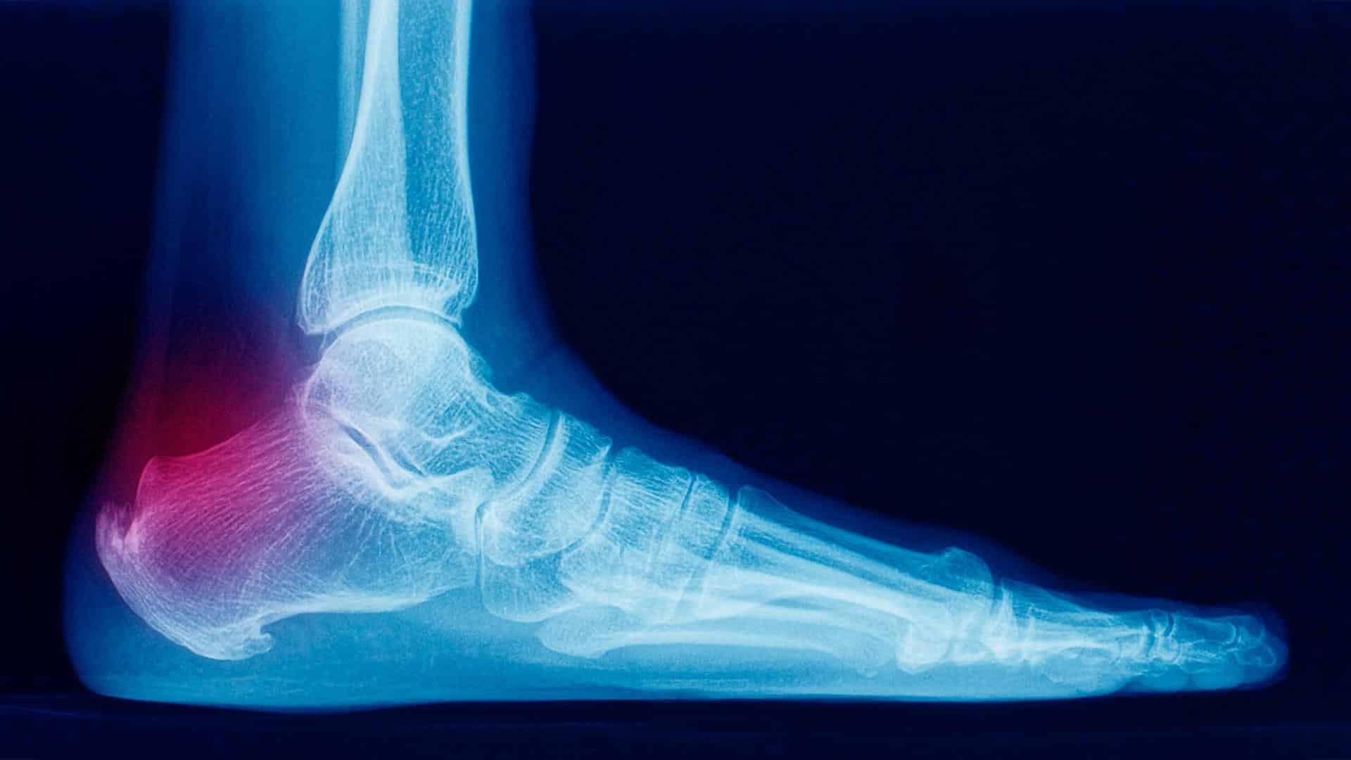 Tendão de Aquiles visto em radiografia