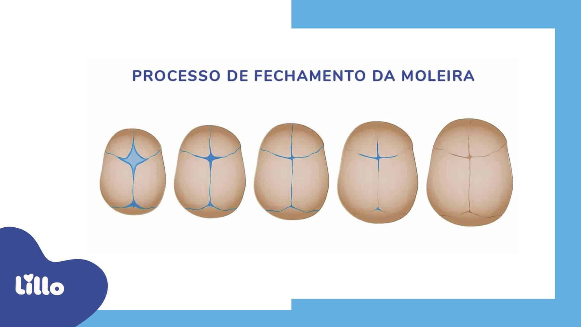 Processo de fechamento da moleira