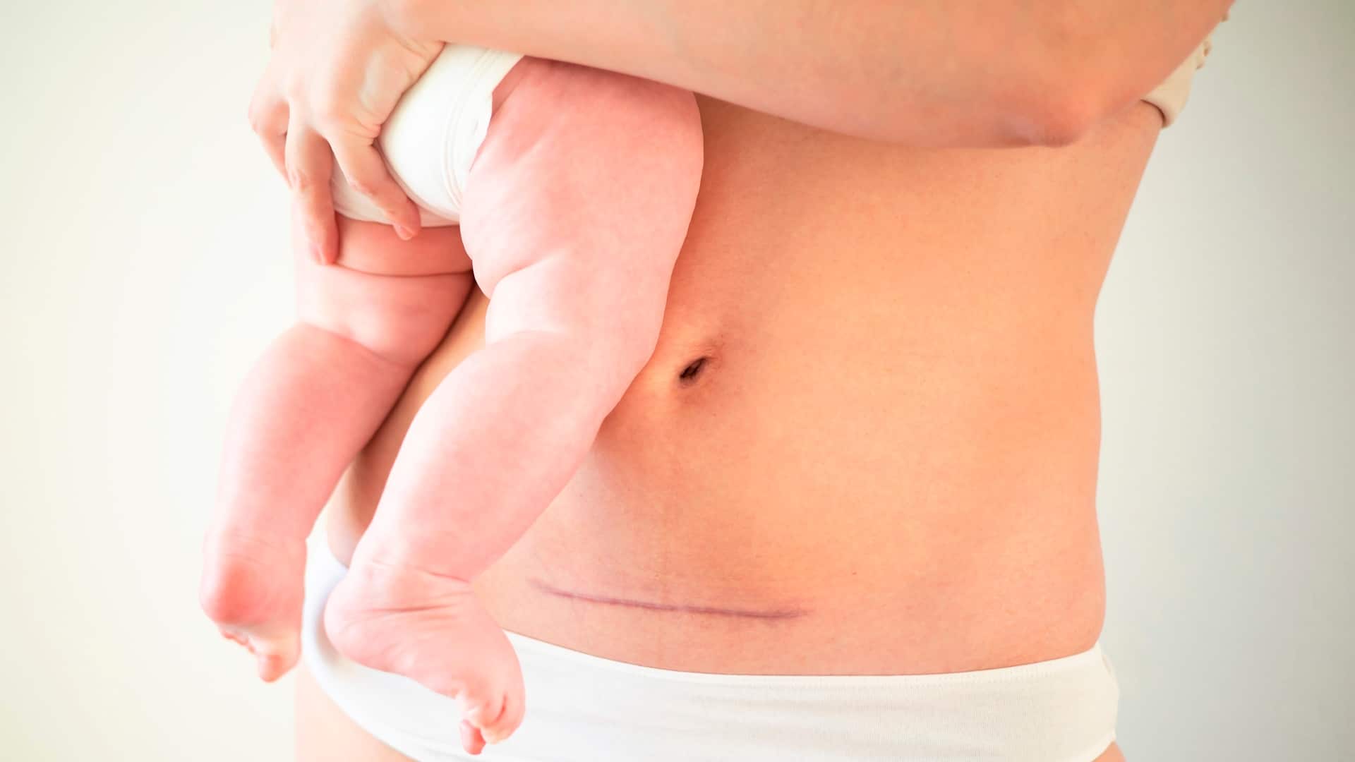 Mãe segurando o bebê, com cicatrização cesariana à vista