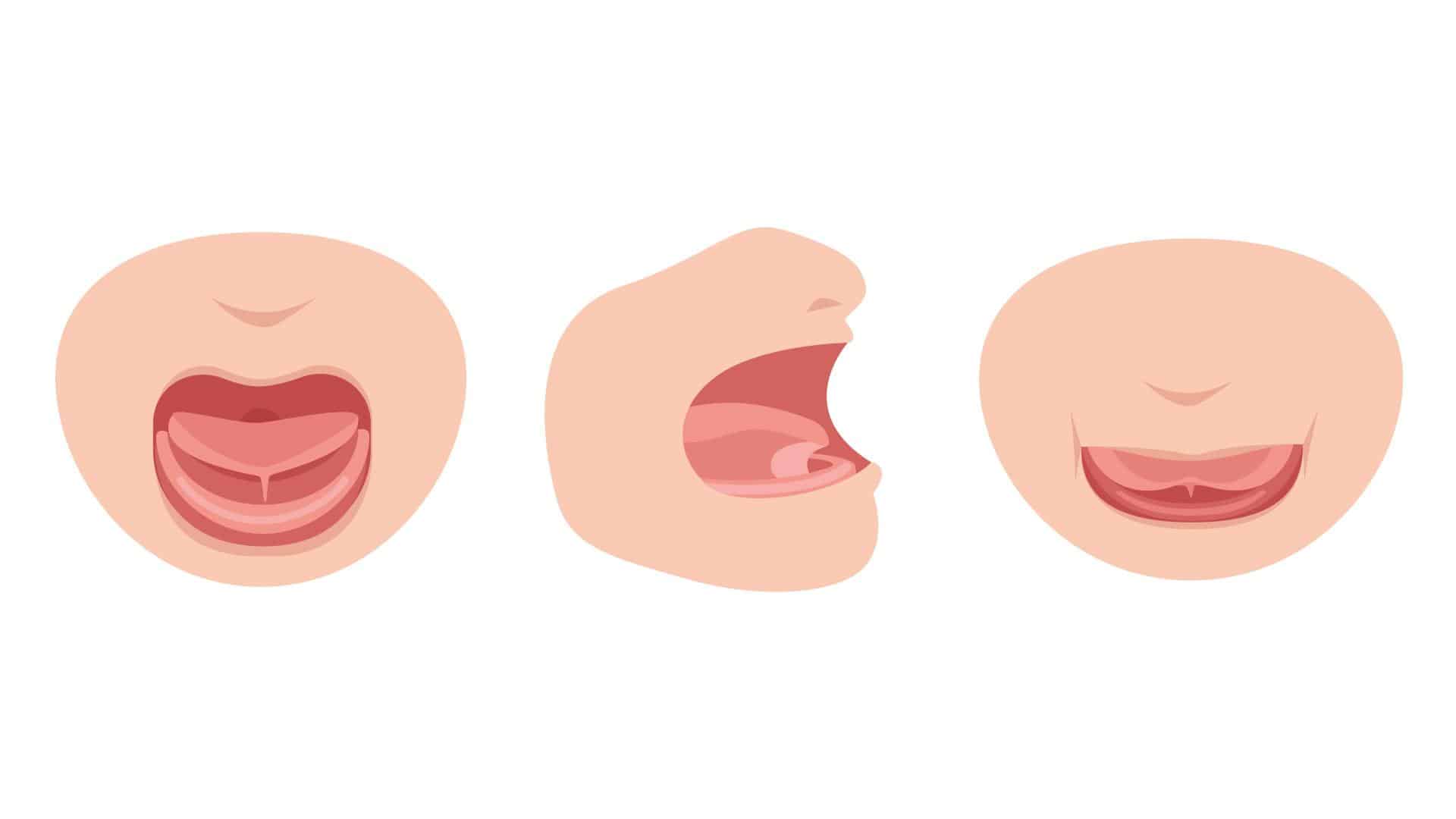 Ilustração de língua presa no bebê