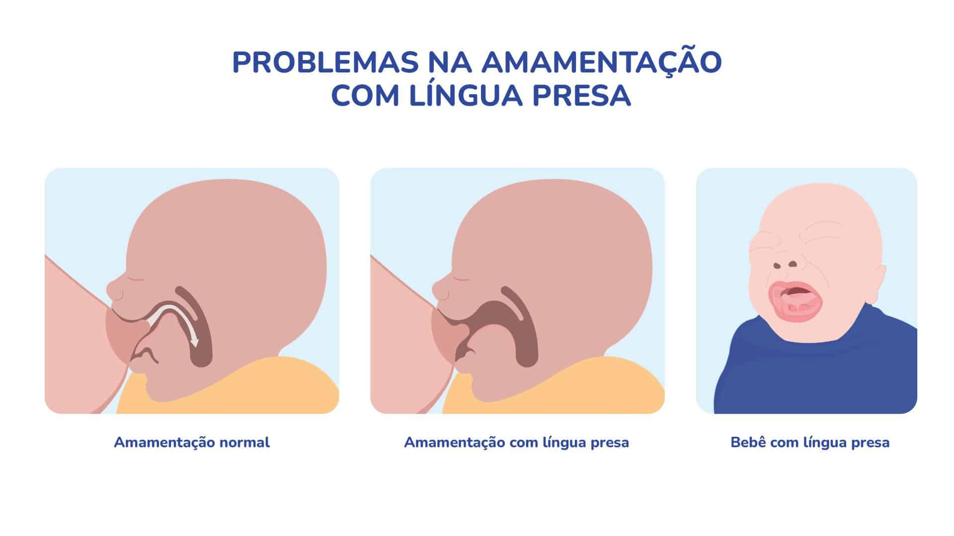 A língua presa no bebê interfere na amamentação