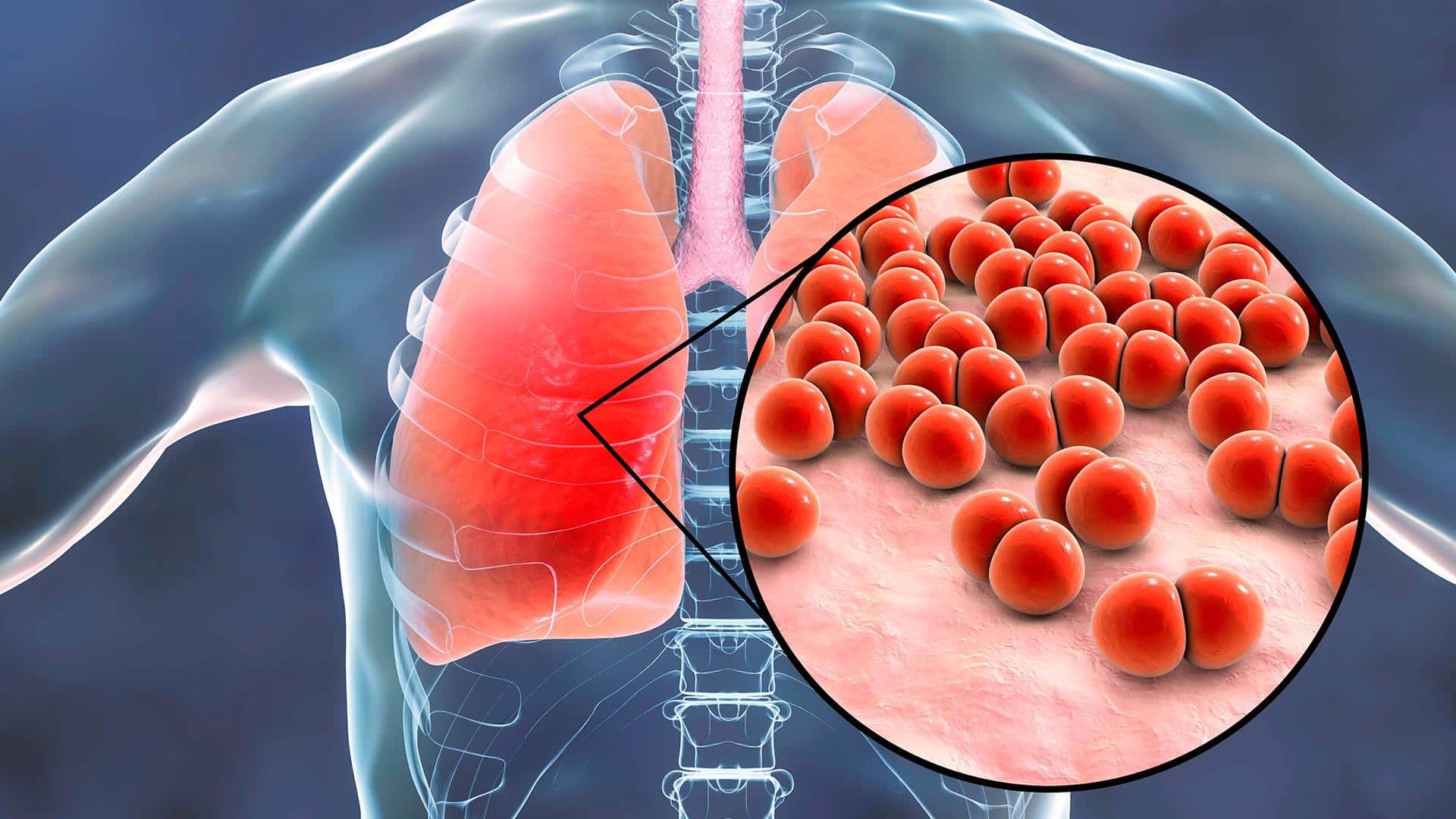 A otite em bebê pode ter relação com a pneumonia